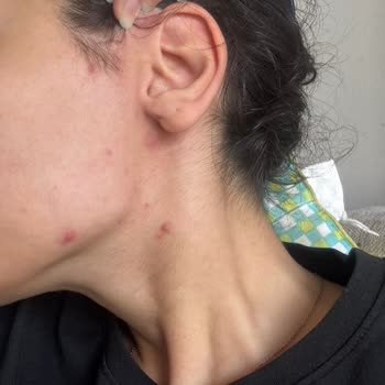 Сыворотка Vichy Liftactiv Collagen Specialist Serum вызвала акне и боль на коже