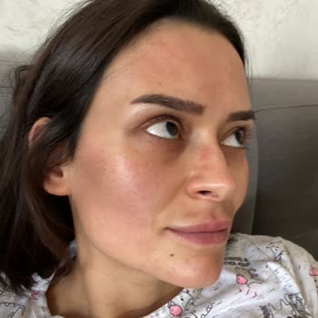 Cilt Tedavisi Sonrası Lekelerim Arttı, Şikayetim Dikkate Alınmadı