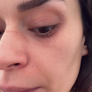 Cilt Tedavisi Sonrası Lekelerim Arttı, Şikayetim Dikkate Alınmadı