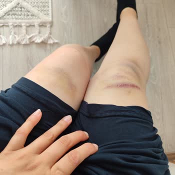 Spor Salonunda Yetersiz Hijyen Ve Güvenlik Önlemleri Nedeniyle Yaşadığım Sağlık Sorunu