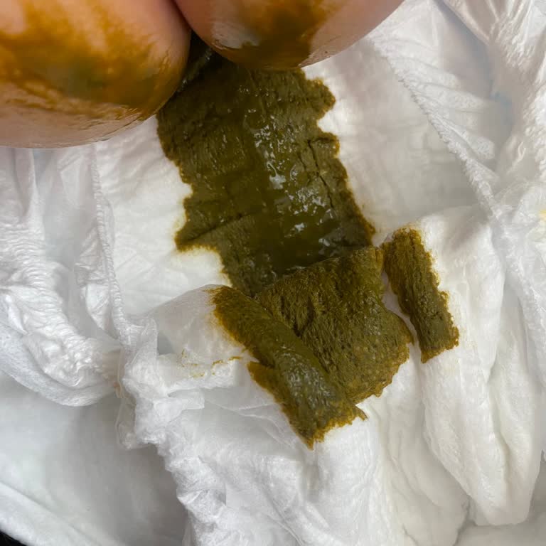 Aptamil Prosyneo Sonrası Bebeğimde Yeşil Kaka Problemi