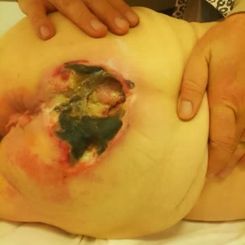 Yoğun Bakımda Annemin İhmali Ve Yüksek Tedavi Ücreti Mağduriyeti