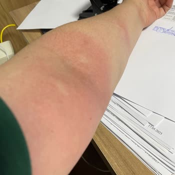 Bioblas Aldığım Şampuan Sonrası Yaşadığım Sağlık Sorunları