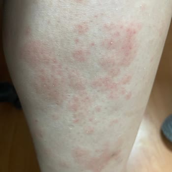 Bioblas Aldığım Şampuan Sonrası Yaşadığım Sağlık Sorunları