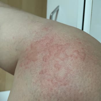 Bioblas Aldığım Şampuan Sonrası Yaşadığım Sağlık Sorunları