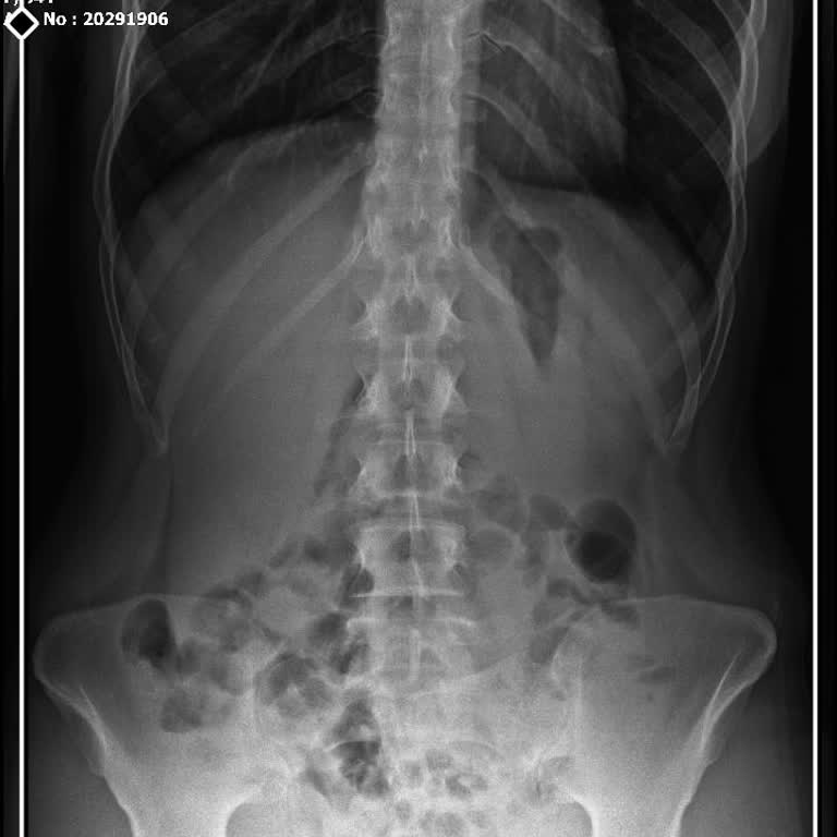 Yanlış Teşhis Ve Yetersiz İlgi Nedeniyle Mağduriyet