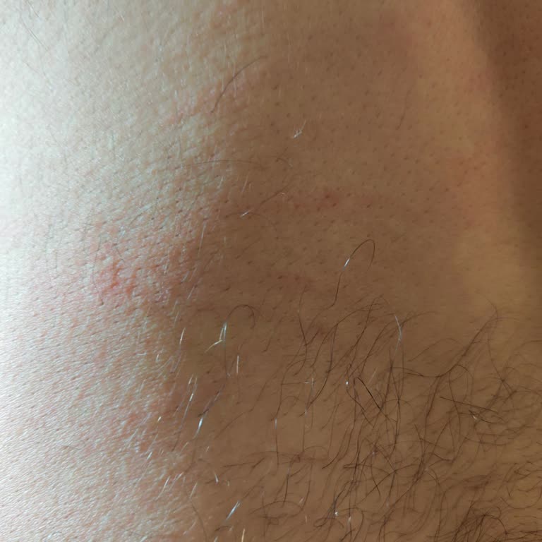 İlk Kapsülden Sonra Cildimde Kabarma Ve Kaşıntı Yaşadım