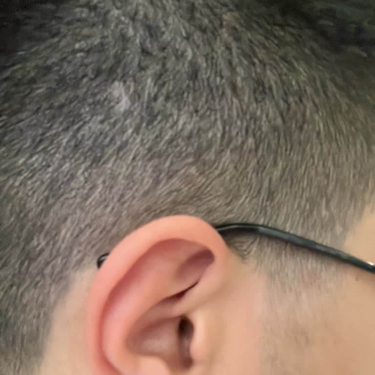 Berberde Hatalı Tıraş Ve İlgisizlik Nedeniyle Mağduriyet