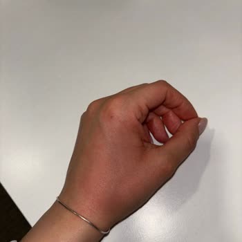 Stanley Termosun Akıntısı Elimi Yaktı