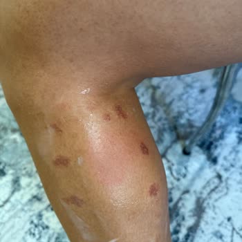 Epilasyon Sonrası Oluşan Ciddi Yanıklar Ve Merkezin Yetersiz Çözümü