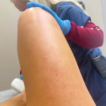 Epilasyon Sonrası Oluşan Ciddi Yanıklar Ve Merkezin Yetersiz Çözümü