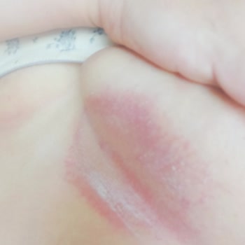 Penti Sütyen Cildimde Yaraya Sebep Oldu