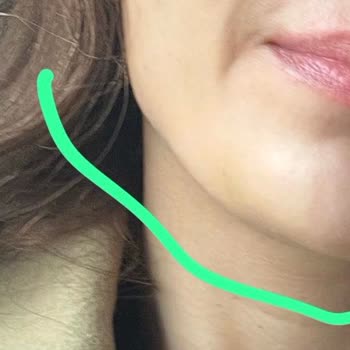 Dolgu Sonrası Yamuk Jawline Ve Ekstra Ücret Şoku