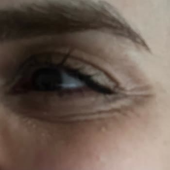 Dolgu Sonrası Yamuk Jawline Ve Ekstra Ücret Şoku