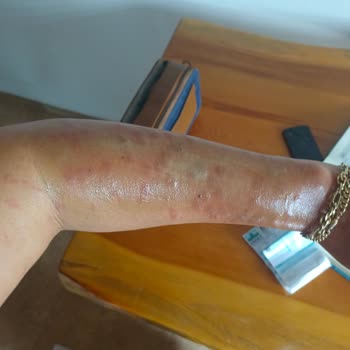 Yanlış İşlem Sonucu Kollarımda 3 Derece Yanık Ve Kalıcı İz Oluştu