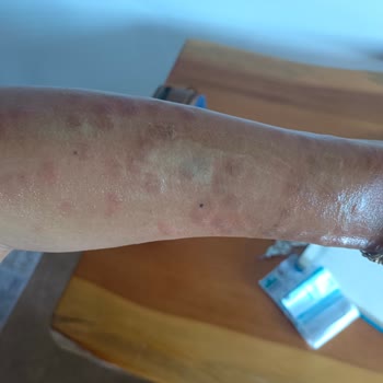 Yanlış İşlem Sonucu Kollarımda 3 Derece Yanık Ve Kalıcı İz Oluştu