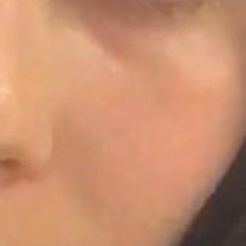 Dove Katı Sabun Yüzümde Kalıcı Kızarıklık Ve Kuruluk Yaptı