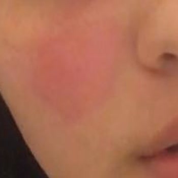 Dove Katı Sabun Yüzümde Kalıcı Kızarıklık Ve Kuruluk Yaptı