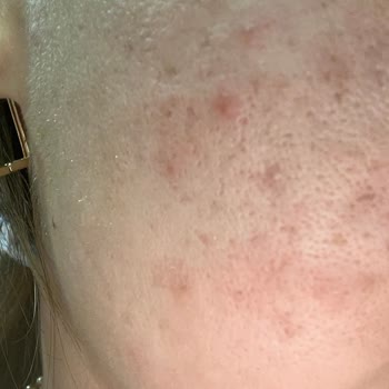 Aldığım Güneş Kremi Yüzümde Alerji Ve Yanma Yaptı, Para İadesi Talep Ediyorum