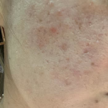 Aldığım Güneş Kremi Yüzümde Alerji Ve Yanma Yaptı, Para İadesi Talep Ediyorum