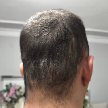 Saç Ekimi Sonrası Donör Bölge Sorunu Ve Memnuniyetsizlik