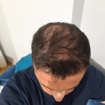 Saç Ekimi Sonrası Donör Bölge Sorunu Ve Memnuniyetsizlik