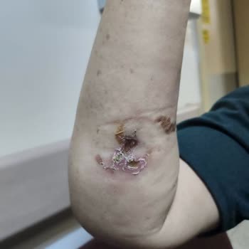 Acil Serviste İhmalkarlık Ve Yanlış Tedavi: Annemin Kolu Yandı!