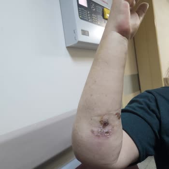 Acil Serviste İhmalkarlık Ve Yanlış Tedavi: Annemin Kolu Yandı!