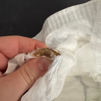 Bebek Bezinde Sakız Gibi Yabancı Maddeyle Karşılaştım