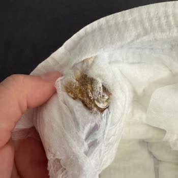 Bebek Bezinde Sakız Gibi Yabancı Maddeyle Karşılaştım