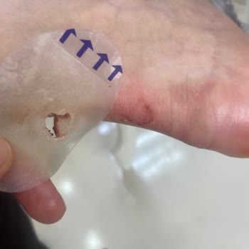 Ayakkabının Arka Dikişleri Ayaklarımı Ciddi Şekilde Yaraladı, İade Talep Ediyorum