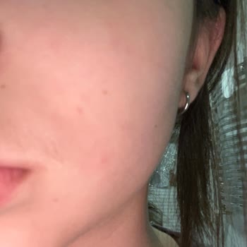 L'Oréal Paris Face Sunscreen Caused Redness and Bumps on My Sensitive Skin in One Day