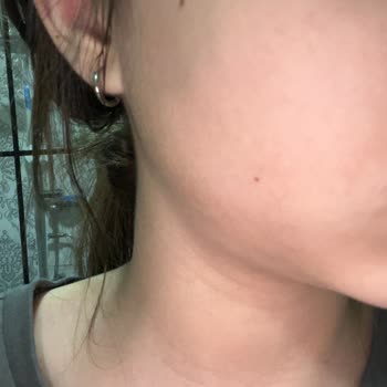 L'Oréal Paris Face Sunscreen Caused Redness and Bumps on My Sensitive Skin in One Day