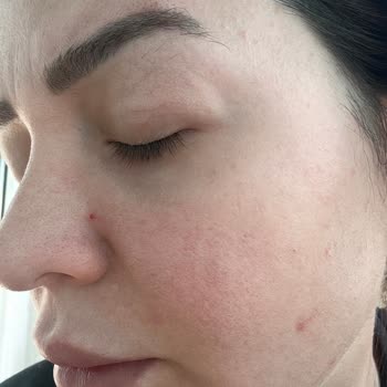 Estee Lauder Serum and Cream Severely Dried Out My Skin and Caused Breakouts