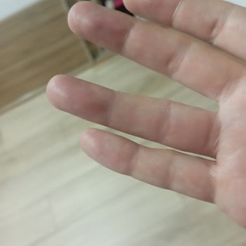 Yanlış Teşhis Nedeniyle Kalıcı Parmak Hasarı Ve İlgisiz Doktor Deneyimi