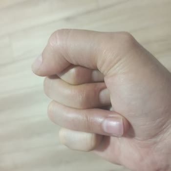 Yanlış Teşhis Nedeniyle Kalıcı Parmak Hasarı Ve İlgisiz Doktor Deneyimi