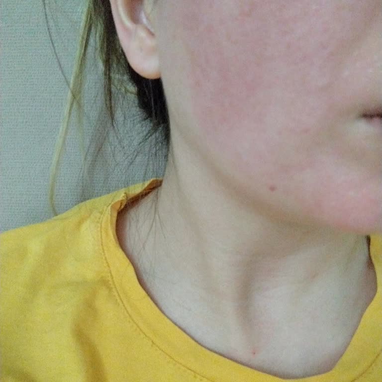 Bioderma Pigmentbio C-concentrate İlk Kullanımda Yoğun Yanma Ve Kızarıklık