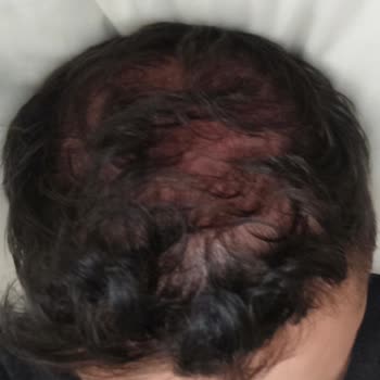 Saç Ekimi Sonrası Memnuniyetsizlik Ve Eşitsiz Hizmet Deneyimi