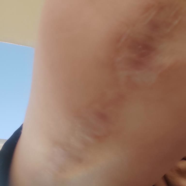 Kol Germe Ameliyatı Sonrası Kötü Dikiş Ve İlgisizlik Mağduriyeti