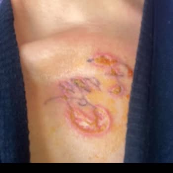 Dövme Silme Sonrası Keloid Ve İlgisizlik Mağduriyeti