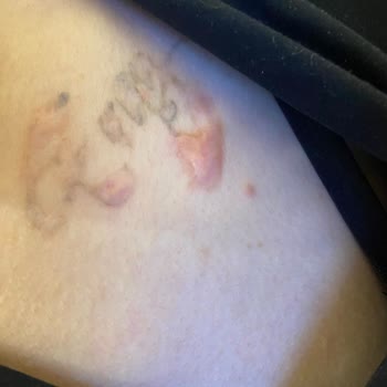 Dövme Silme Sonrası Keloid Ve İlgisizlik Mağduriyeti