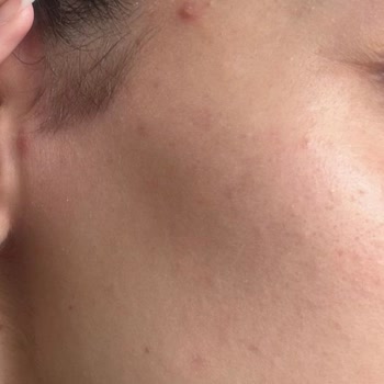 Vichy Liftactiv Collagen Specialist Serum Ruined My Skin with Painful Acne