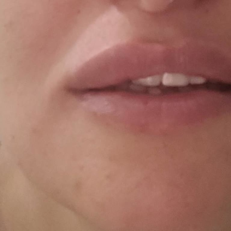 Dudak Dolgusu Sonrası Asimetri Ve Enfeksiyon Sorunu Yaşadım