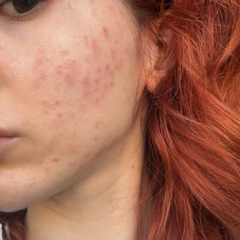 BB Life Güzellik Yanlış Uygulanan Cilt Bakımı Sonrası Cilt Sorunları Ve Memnuniyetsizlik!