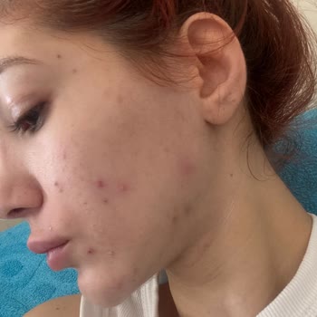 BB Life Güzellik Yanlış Uygulanan Cilt Bakımı Sonrası Cilt Sorunları Ve Memnuniyetsizlik!