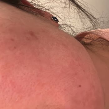 Solicito reembolso por reacción alérgica tras usar Solgar Omega 3, D Vitamina, Iron y Magnesio