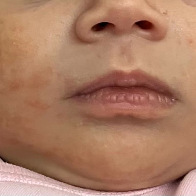 Mustela Şampuan Bebeğimde Cilt Sorunları Ve Egzama Benzeri Reaksiyonlara Yol Açtı