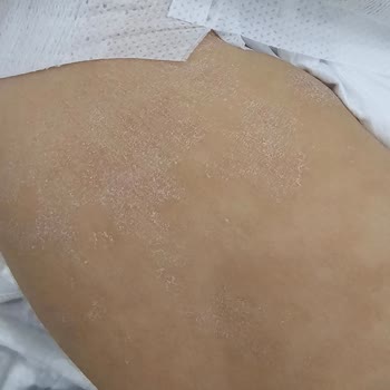 Mustela Avokado Özlü Vücut Losyonu Egzama Yaptı