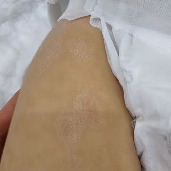 Mustela Avokado Özlü Vücut Losyonu Egzama Yaptı