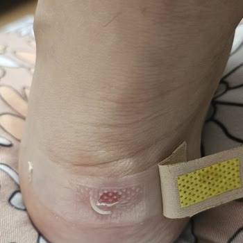 Yeni Alınan Ayakkabı Çocuğumun Ayağında Derin Yaralar Oluşturdu